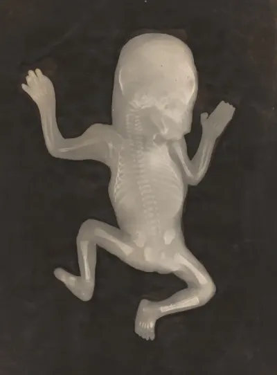 Degree of Ossification of a Five-Month-Old Fetus (Degré d'ossification d'un Foetus de cinq mois)