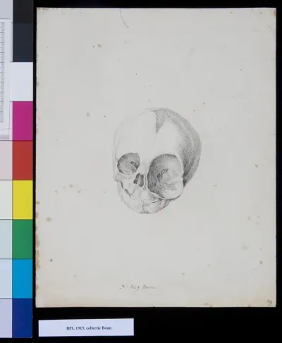 Dformed skull of newly born child