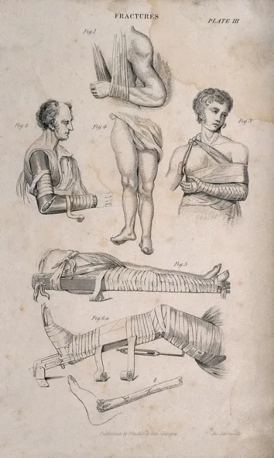 Diagrams illustrating how to bandage and set fractures in splints