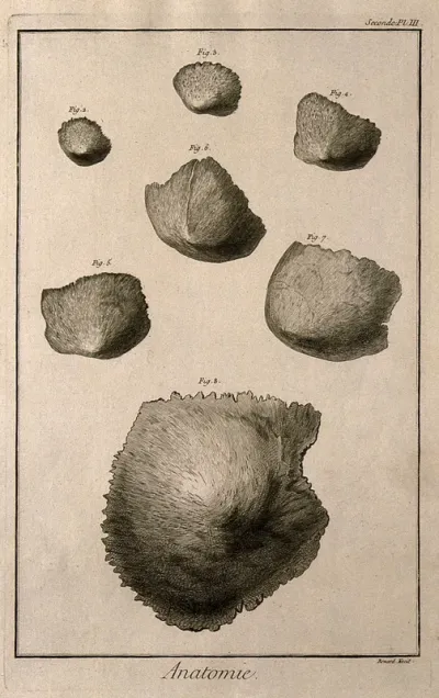 Different degrees of ossification of the parietal bone of the skull