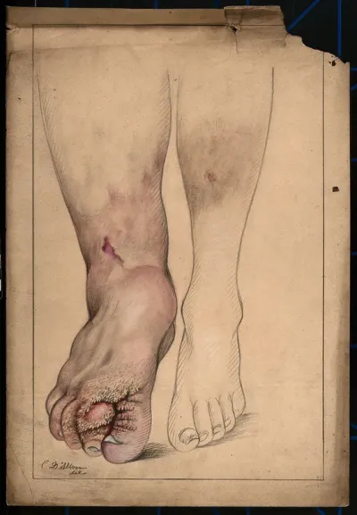 Diseased and deformed foot, ankle and lower leg of a man