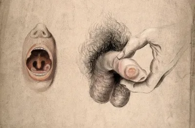Diseased areas of tissue in the mouth, close to the tonsils, and on the penis: two figures