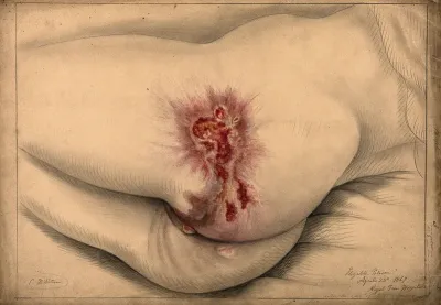 Diseased areas of tissue on the buttocks and genitals of a woman