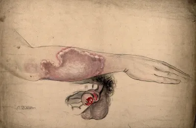 Diseased areas of tissue on the penis and lower arm of a man