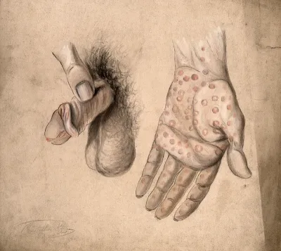Diseased areas of tissue on the penis and the palm of the hand of a man: two figures
