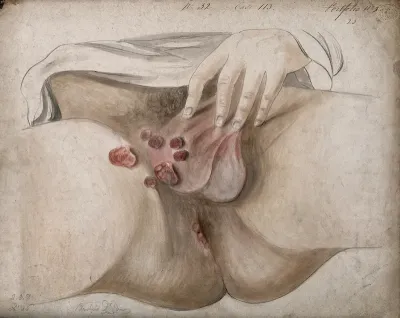 Diseased areas of tissue on the scrotum, rectum and groin of a man
