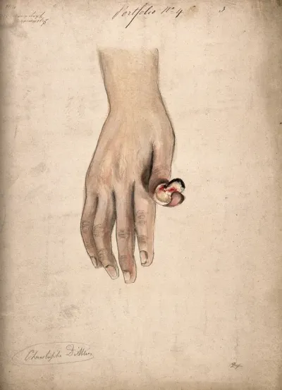 Diseased, deformed thumb showing symptoms of diphtheritic phagedena