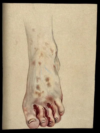 Diseased foot and toes