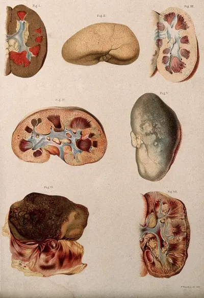 Diseased kidneys: seven examples