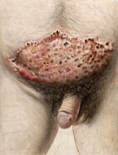 Diseased lower abdomen and groin area of a man