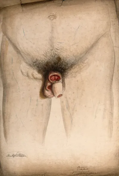 Diseased penis and scrotum with swellings or ganglions in the groin area