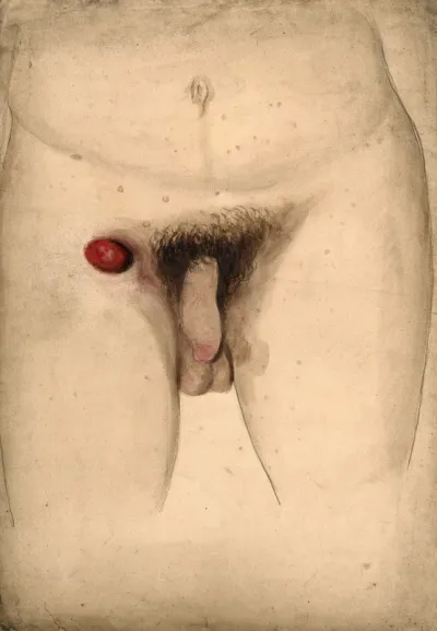 Diseased penis with a large red swelling or abcess in the groin area