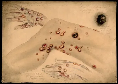 Diseased skin and boils on the hands, head and leg of a woman, showing symptoms of 'pustular itch'
