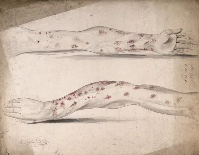 Diseased skin and sores on the arms of a man