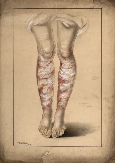 Diseased skin on the legs of a man suffering from psoriasis