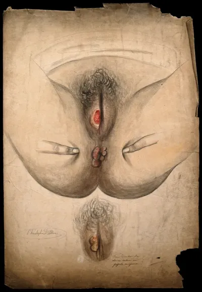 Diseased skin surrounding the anus and genitalia of a woman, with a detail of the area after treatment (?) Watercolour by C