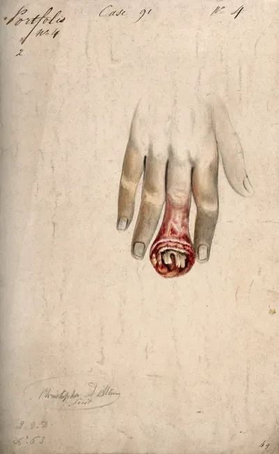 Diseased, swollen fingertip, with bone shown protruding from the open wound