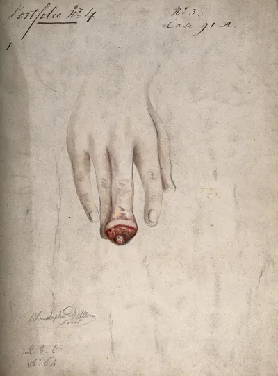 Diseased, swollen fingertip