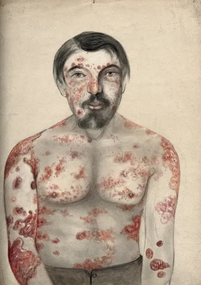 Diseased tissue on the face, shoulders arms and torso of a man suffering from psoriasis and possibly syphilis