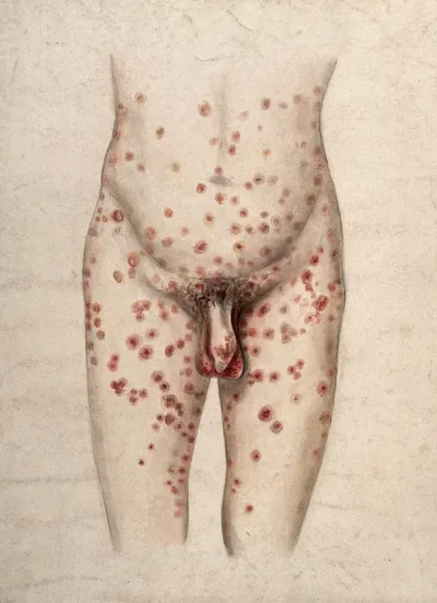 Diseased tissue on the genitals of a man, with a rash of sores covering his abdomen and thighs