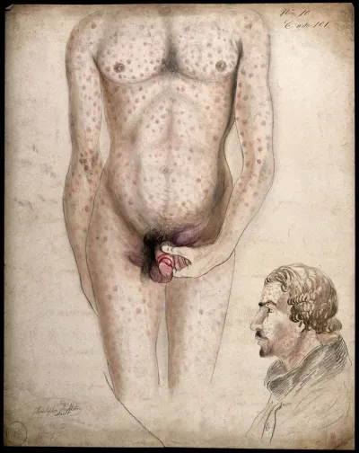 Diseased tissue on the genitals of a man, with a rash of sores covering his entire face and body: two figures, one showing the body, the other the man's face in profile