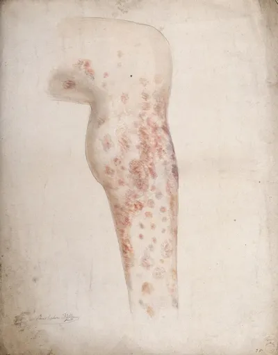 Diseased tissue on the lower leg of a man