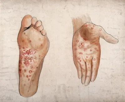 Diseased tissue on the palm of the hand and sole of the foot of a man