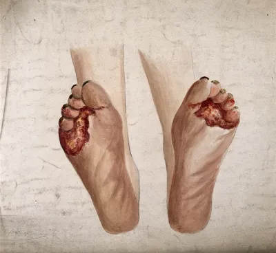 Diseased tissue on the soles of the feet of a woman