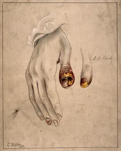 Diseased tissue on the thumbs and fingers of a woman, showing symptoms of syphilitic onychia