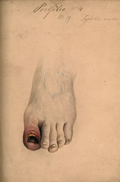 Diseased tissue on the toe and nail of a woman (?), showing symptoms of syphilitic onychia