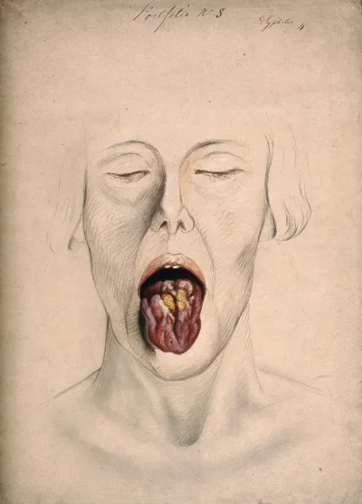 Diseased tissue on the tongue of a woman suffering from syphilis