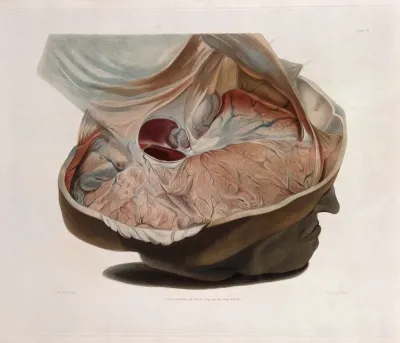 Dissected head of James Cardinal with top of skull removed to expose brain deformation