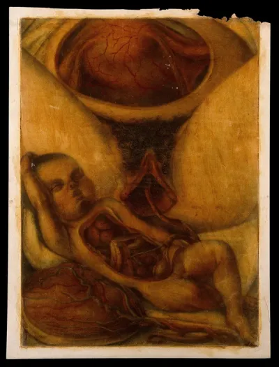 Dissection of a foetus and the womb of the mother, shortly after birth