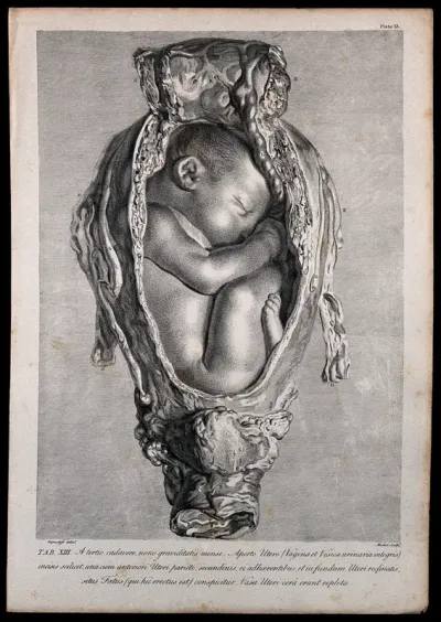 Dissection of a pregnant uterus, showing the foetus at nine months, with its head facing upwards