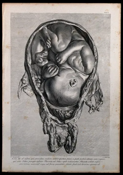 Dissection of a pregnant uterus, showing the foetus at nine months, with the head positioned towards the vagina and the lower part of the placenta under the child's head, detached from the uterus