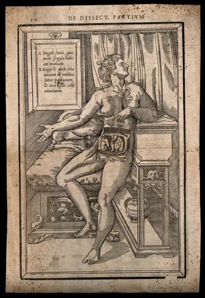 Dissection of the abdomen of a pregnant woman expecting twins: the nude woman is shown seated on a bed, lifting two placentas to reveal the two foetuses