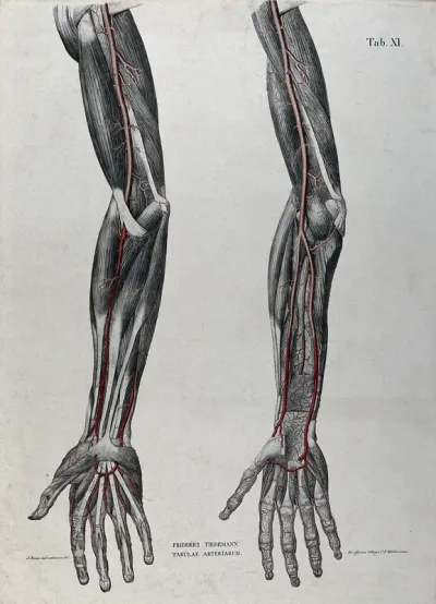 Dissection of the arm and hand; two figures, with the arteries and blood vessels indicated in red