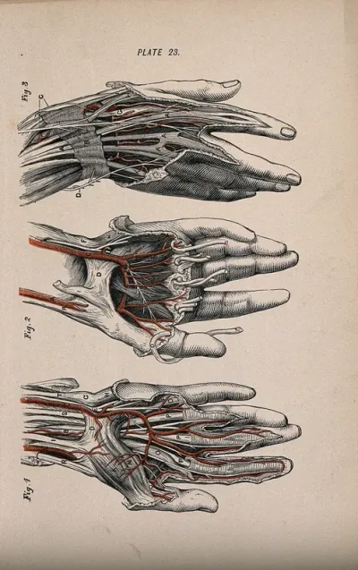 Dissection of the hand and fingers: three figures, showing the tendons and blood vessels