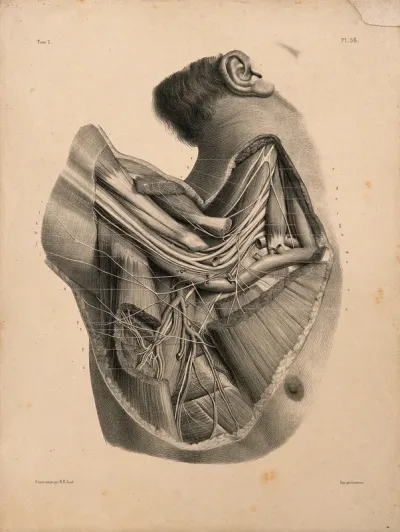 Dissection of the neck and shoulder, showing the brachial plexus
