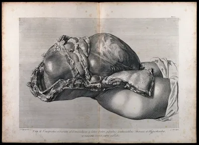 Dissection of the pregnant female abdomen, showing the skin peeled away to reveal the swollen uterus and the viscera, side view