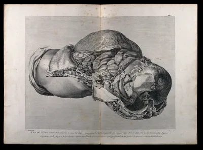 Dissection of the pregnant female abdomen, showing the skin peeled away to reveal the swollen uterus, the diaphragm and the intestines, side view