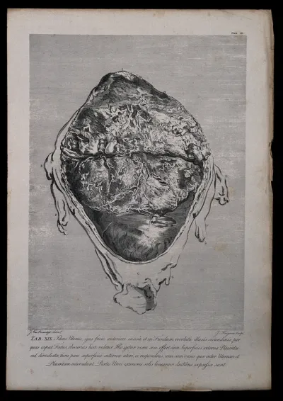 Dissection of the pregnant uterus at eight months