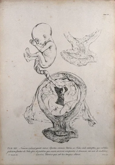 Dissection of the pregnant uterus at five months, showing the foetus removed and the umbilical cord still attached, with a detail showing the cervix