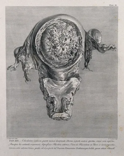 Dissection of the pregnant uterus at five months, showing the placenta and the cervix, in relation to the bladder and urethra