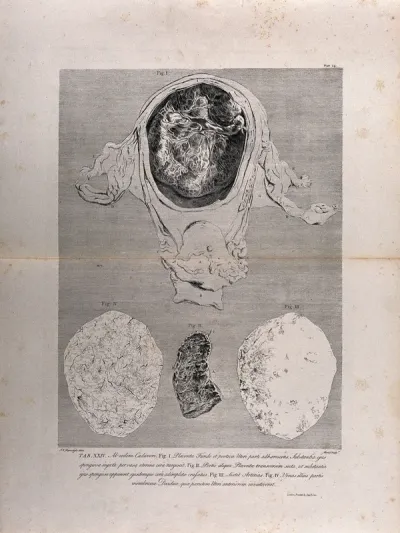 Dissection of the pregnant uterus at six months, showing the placenta and the decidua: four figures