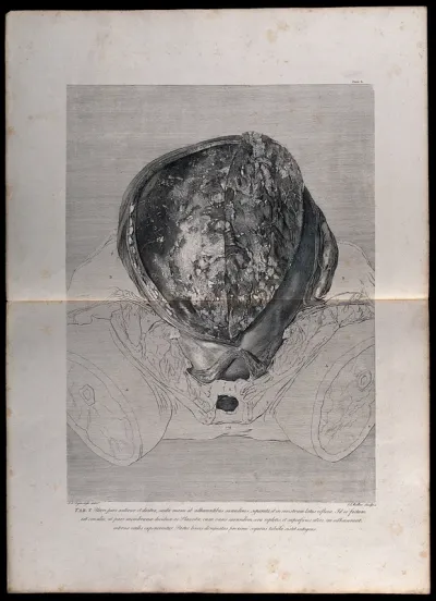 Dissection of the pregnant uterus: initial view of the opened womb