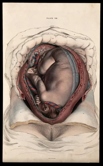 Dissection of the uterus in the latter stages of pregnancy, showing the foetus, placenta and umbilical cord