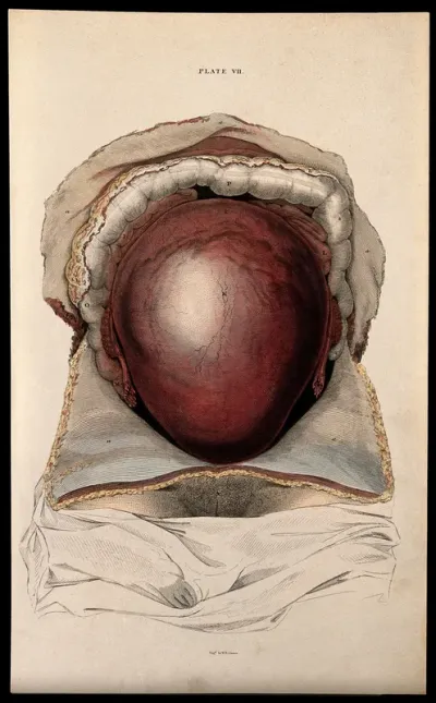 Dissection showing the pregnant uterus