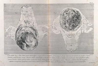 Dissections of a pregnant uterus at five months: two figures, one showing the foetus