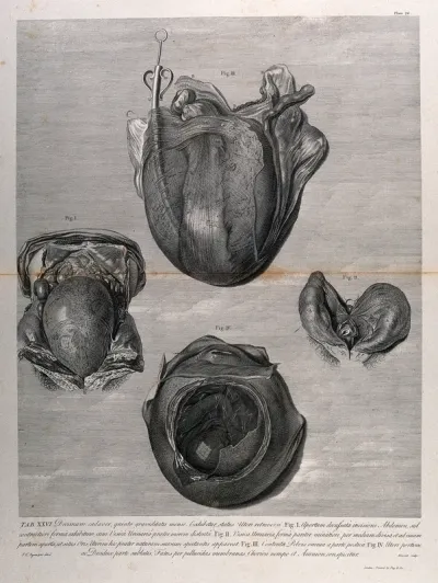 Dissections of a retroverted pregnant uterus, shown with the bladder, at five months: two figures